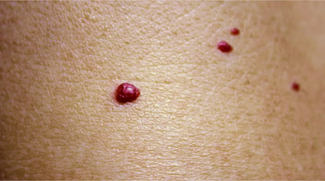Comprendre l'apparition d'un petit point rouge sur la peau
